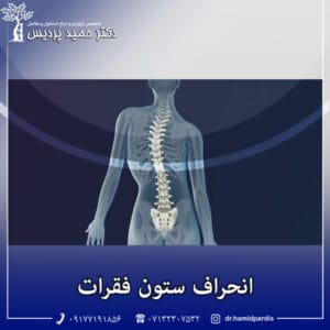 انحراف ستون فقرات - دکتر پردیس