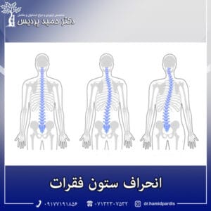 انحراف ستون فقرات - دکتر حمید پردیس