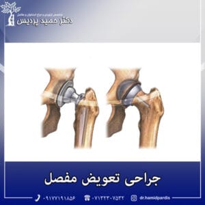 جراحی تعویض مفصل - دکتر پردیس