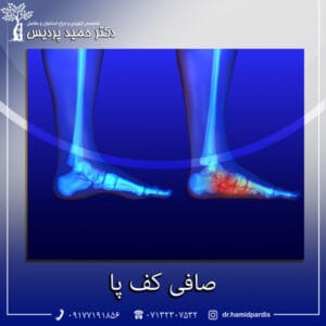 صافی کف پا - دکتر حمید پردیس