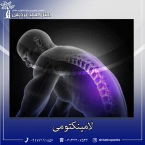 لامینکتومی - دکتر حمید پردیس