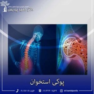 پوکی استخوان - دکتر حمید پردیس