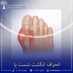 انحراف انگشت شست پا _ دکتر حمید پردیس