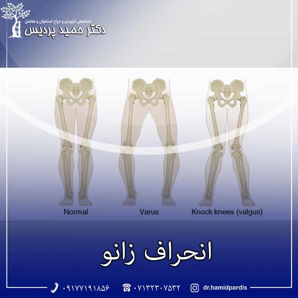 جراحی زانو - دکتر حمید پردیس