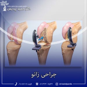 جراحی زانو - دکتر حمید پردیس 