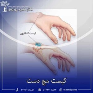 کیست مچ دست - دکتر حمید پردیس