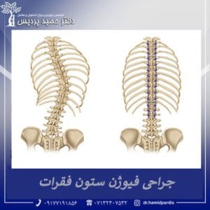 جراحی فیوژن ستون فقرات | دکتر حمید پردیس
