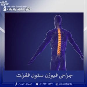 جراحی فیوژن ستون فقرات | دکتر حمید پردیس 