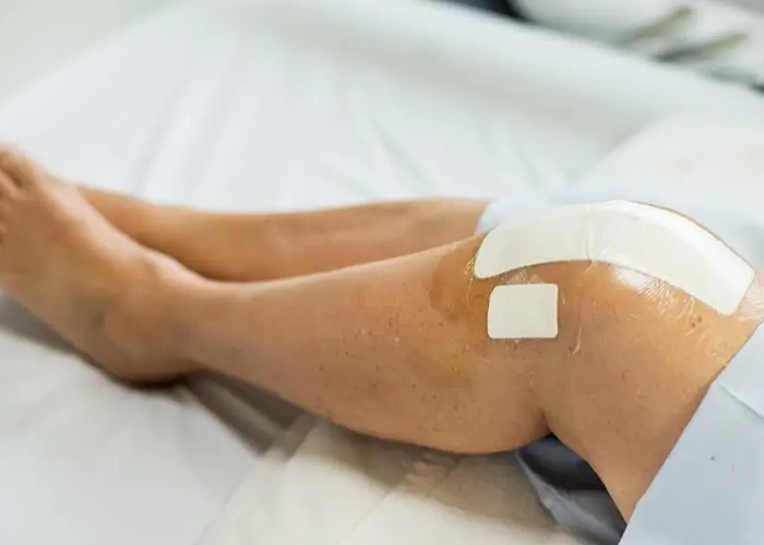 نقش تغذیه در بهبود آسیب رباط صلیبی
