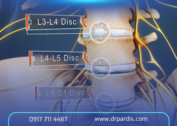 تشخیص دیسک کمر خطرناک